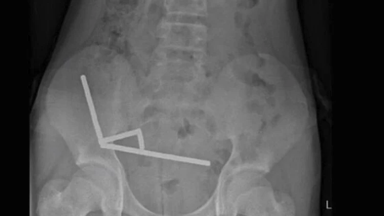 המגנטים החזקים התקבצו יחדיו במעי