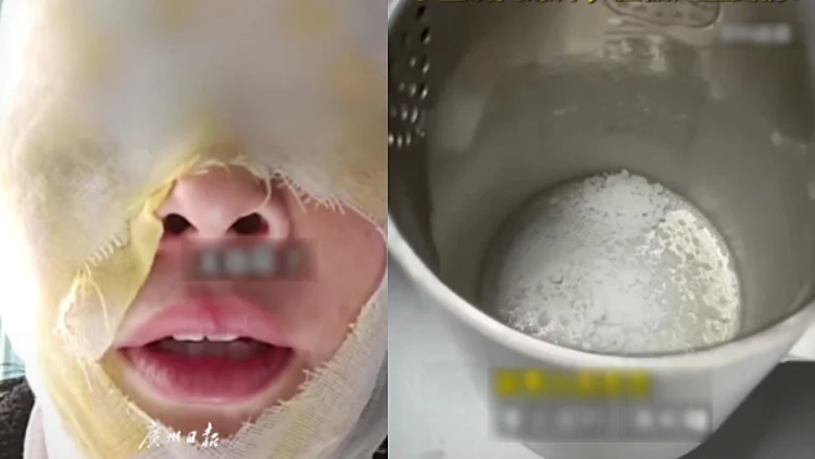 ניסתה לנקות אבנית ונכוותה בפניה