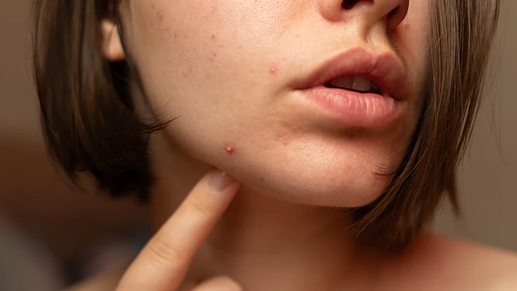 Problem,of,acne,on,the,chin,of,a,young,girl.