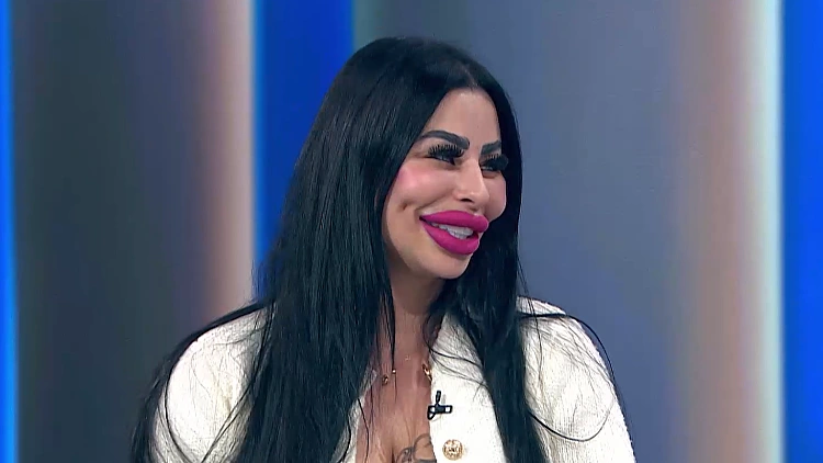 "תחזוקה של שנים": הכירו את האישה שמכורה לניתוחים פלסטיים