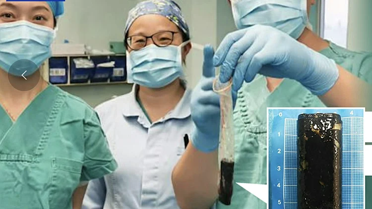 רופאים הסירו מצית שנבלעה לפני 30 שנה