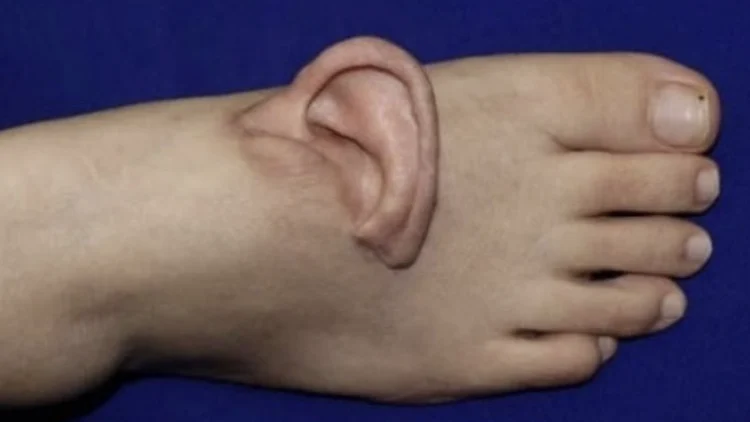 רופאים השתילו אוזן שנתלשה בתאונה על כף רגל של מטופלת