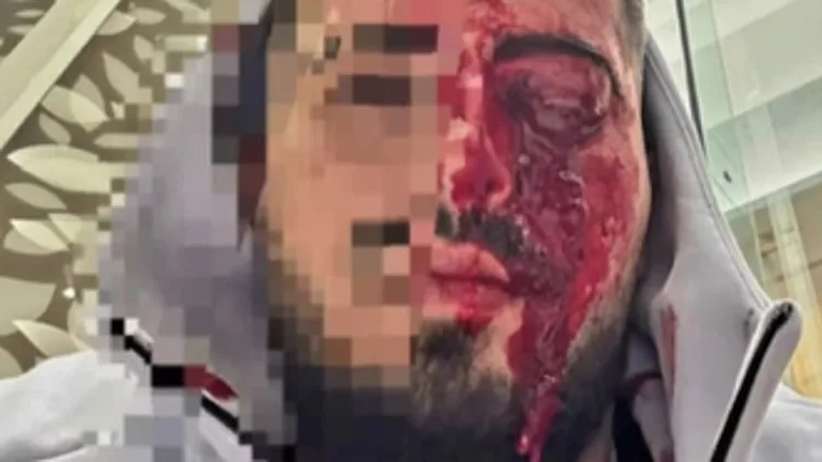 שוחח בעברית בקפריסין, הותקף במכות קשות - ואיבד את עינו