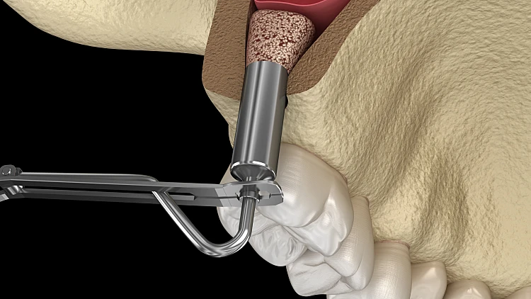 מינימום פולשנות, מקסימום תוצאה: הרמת סינוס סגורה בשיטת אוסיאודנסיפיקציה | רשת 13