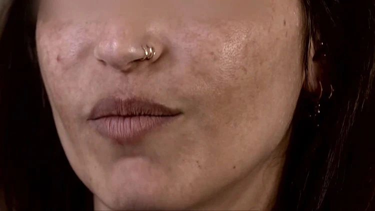 הטיפול המסוכן לפנים בלייזר: "לא מסוגלת להסתכל על עצמי במראה"