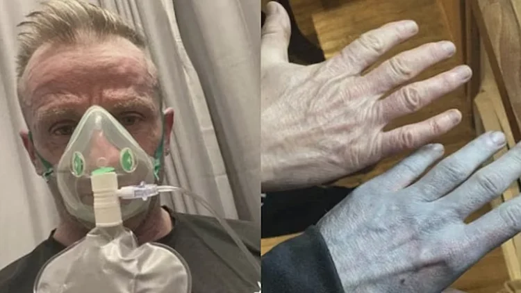 טומי לינץ' התעורר ונראה כמו "אווטאר"