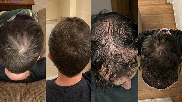 המאבק בדלילות השיער: פריצת הדרך המדעית שמשנה את מה שידענו על שיקום השיער מהשורש