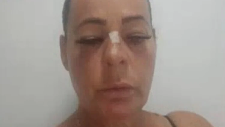 הותקפה בבריכה כי העירה לגבר שצילם קטינות: "כבר לא מסתובבת לבד"