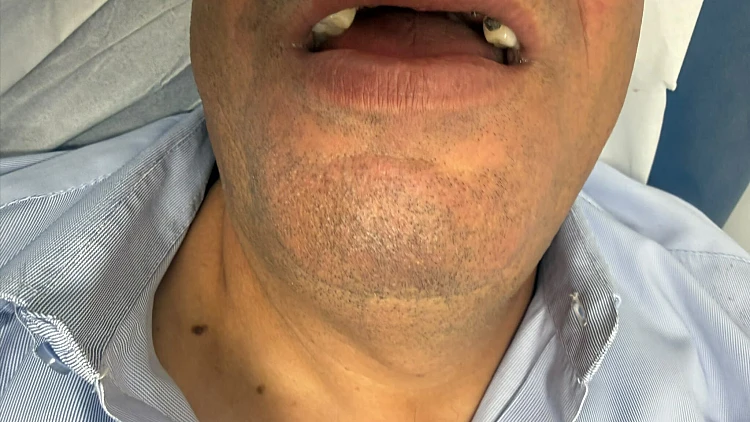 נהג אוטובוס הותקף בי-ם ע"י נערים ששברו את שיניו: "עוד גבול נחצה"