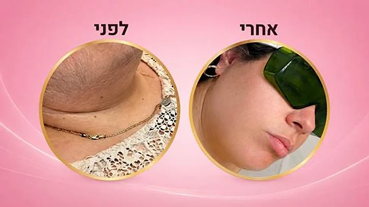 מכון הלייזר בלוד שמציע חוויית טיפול אחרת | רשת 13