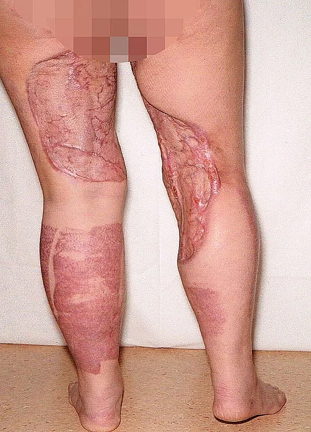 זהירות תמונות קשות: גילחה את שיערה וכמעט איבדה את רגליה