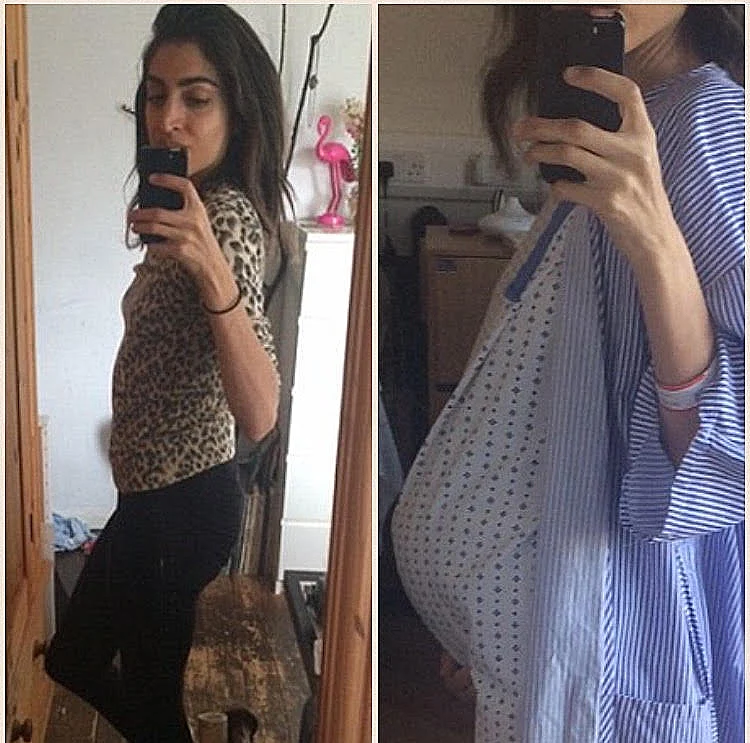 הבטן ההיריונית התגלתה כגידול ענק