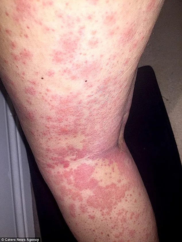 הפריחה מהגילוח התגלתה כסרטן