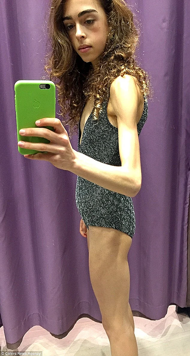 בתקופת האנורקסיה. אכלה 140 קלוריות ביום