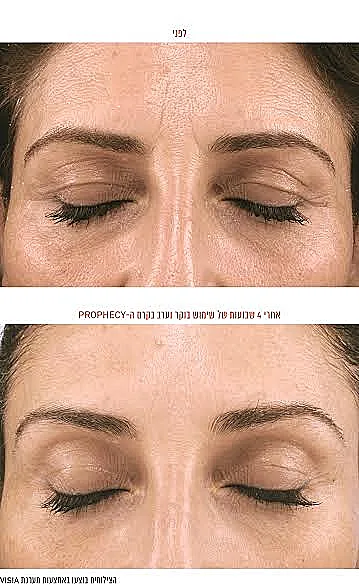 לפני ואחרי: מינוס 18 קילו בשנה וחצי