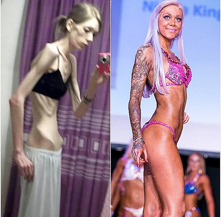 מאנורקסיה קשה למפתחת גוף