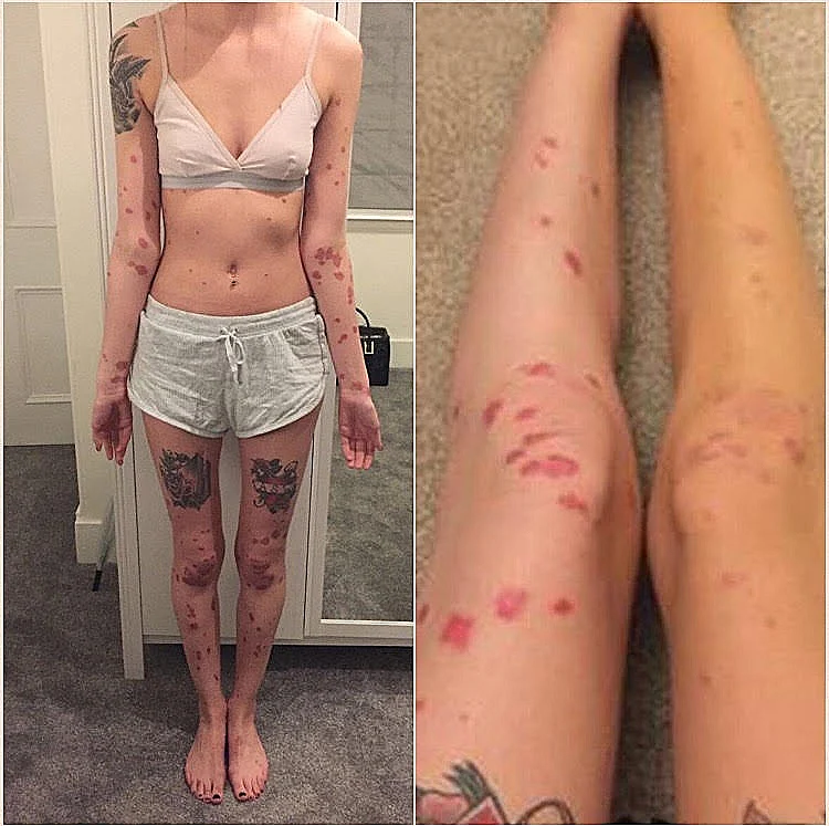 התמלאה בכתמים אדומים בכל גופה וזה מה שהיא גילתה