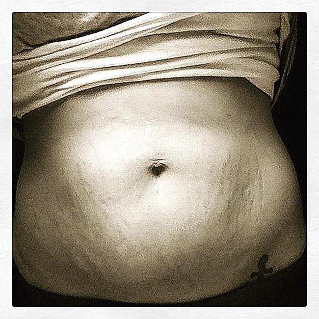 בטן נשית לאחר לידה