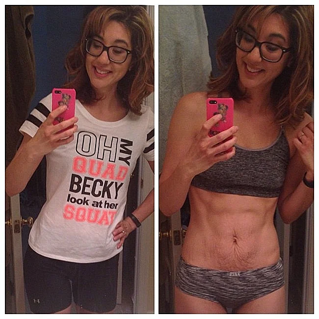 בטן נשית לאחר לידה