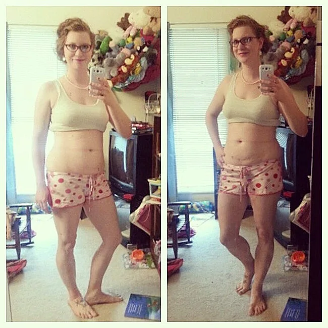 בטן נשית לאחר לידה