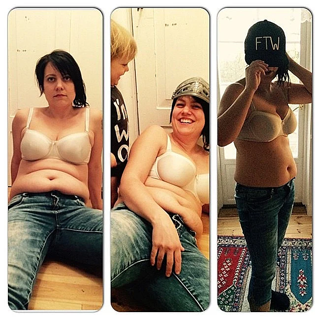 בטן נשית לאחר לידה