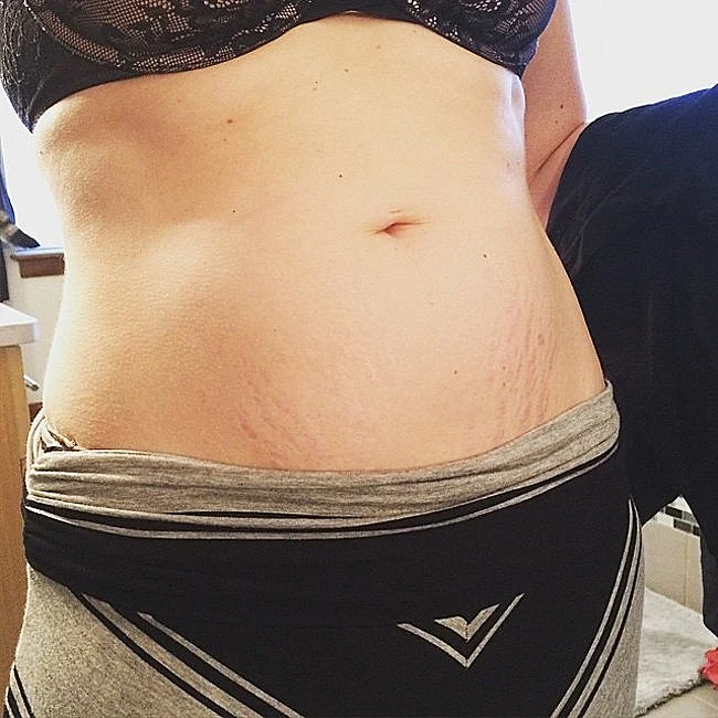 בטן אחרי לידה