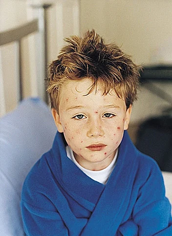 ילדה חולה באבעבועות רוח