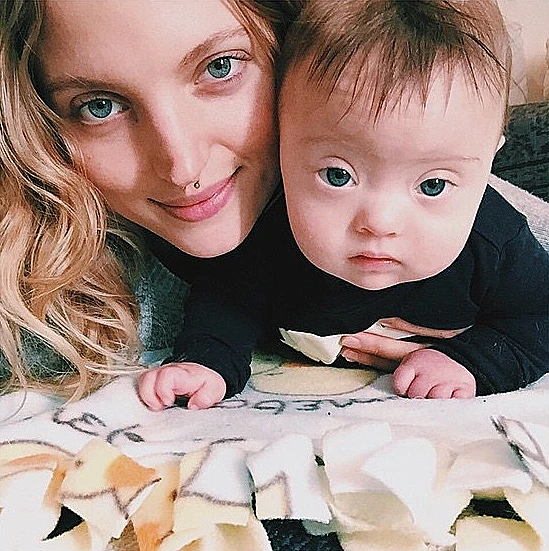 הדוגמנית שבנה סובל מתסמונת דאון