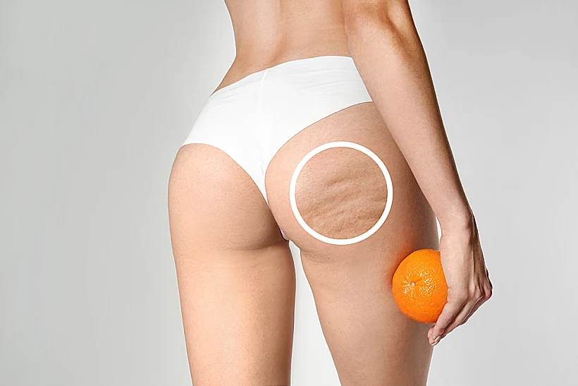 Young,woman,with,orange,on,light,background.,problem,of,cellulite