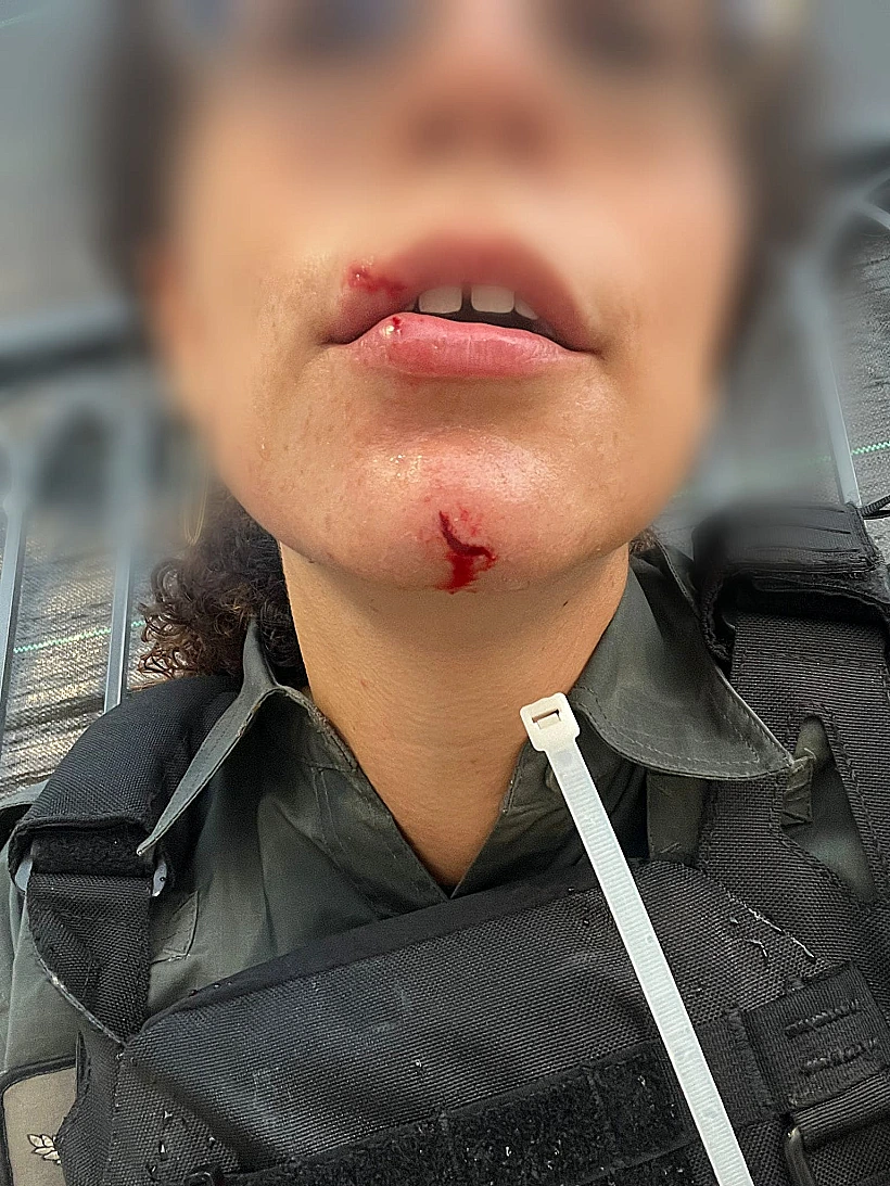 שוטרת מקבלת טיפול רפואי