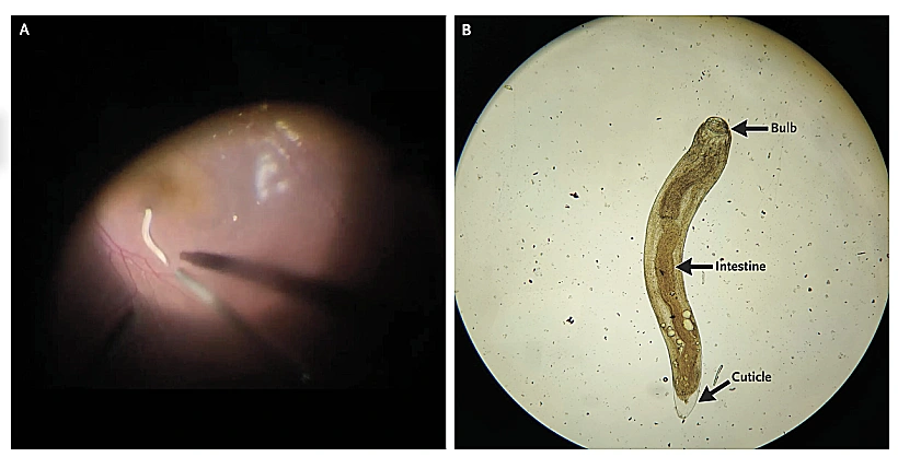 Gnathostoma Spinigerum