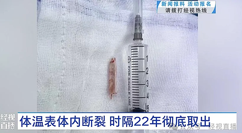 שבר המדחום שהוסר מעכוזה של המטופלת