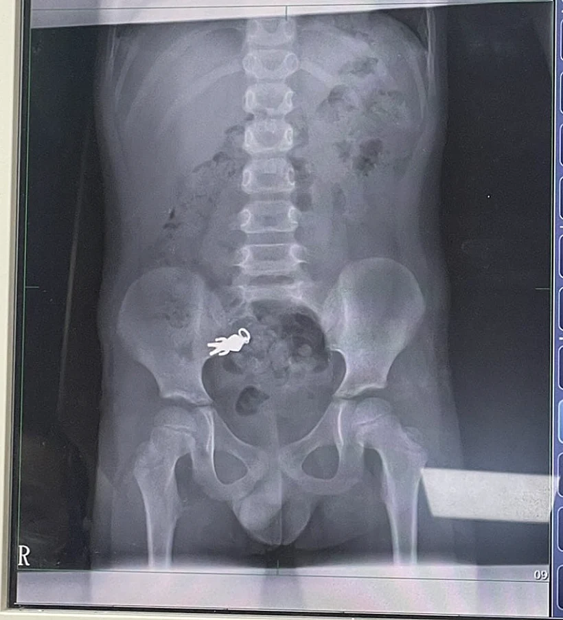 צילום רנטגן