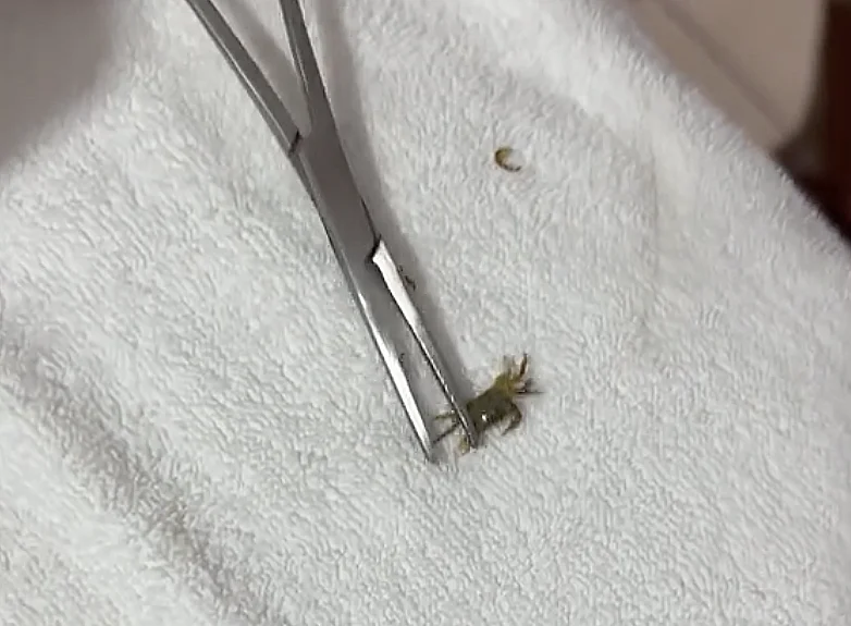 הסרטן שנמצא באוזנו של פדרו