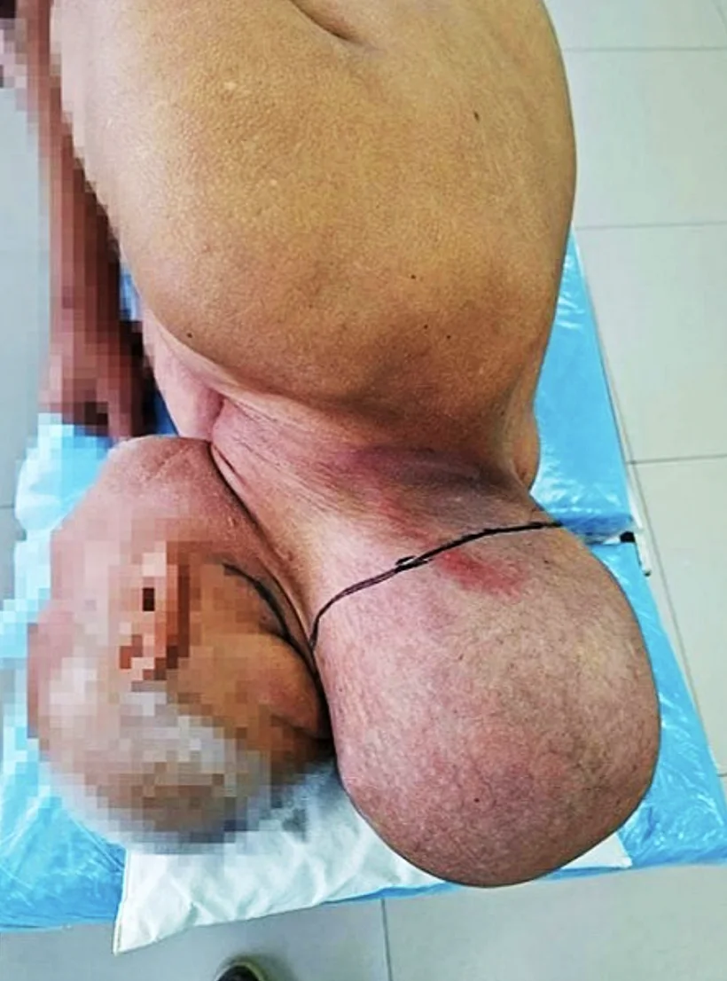 הגידול שצמח על צווארו של המטופל