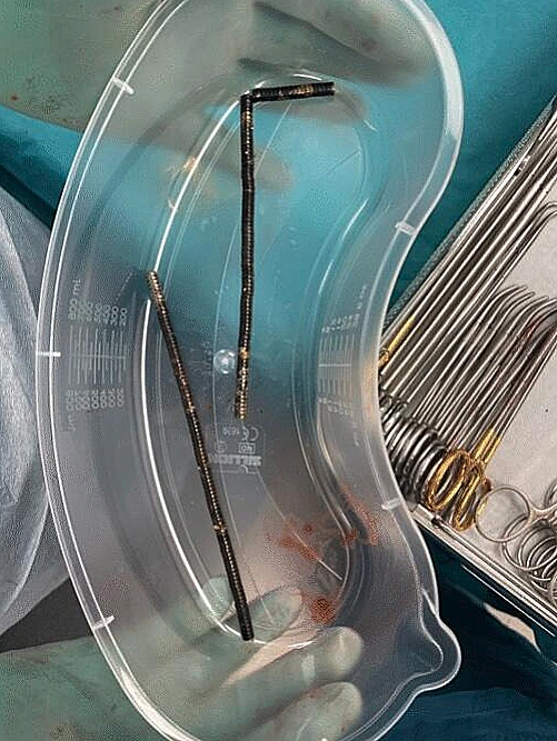 המגנטים שחולצו מגופו של הנער