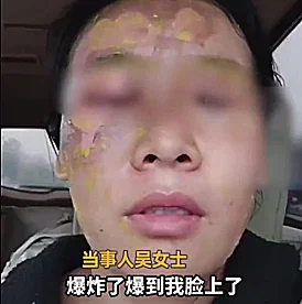 ניסתה לנקות אבנית ונכוותה בפניה