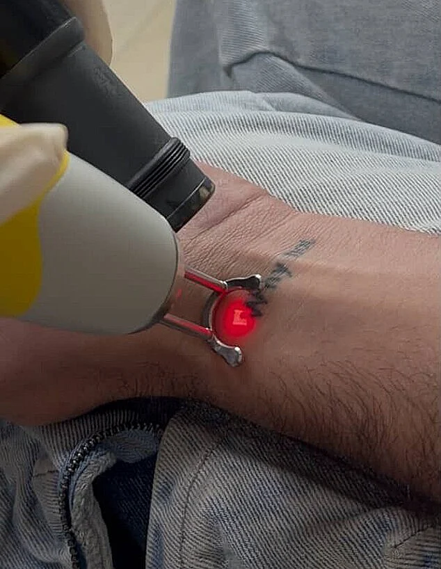 הסרת הקעקוע של חן קראוניק