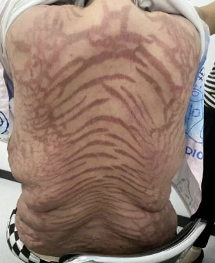 הגב של המטופלת