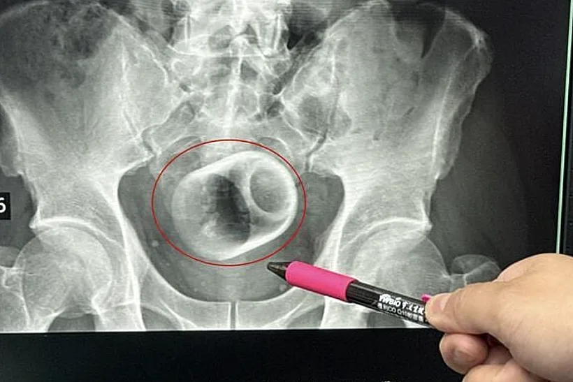 הכוס שנמצאה בגופו של הטופל