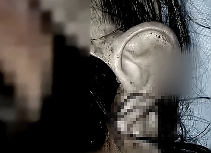 רופאים השתילו אוזן על כף רגלה של מטופלת