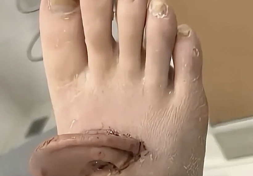 רופאים השתילו אוזן על כף רגלה של מטופלת