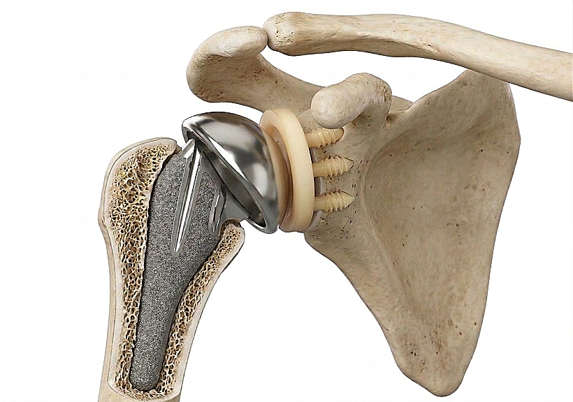 החלפת כתף אנטומית