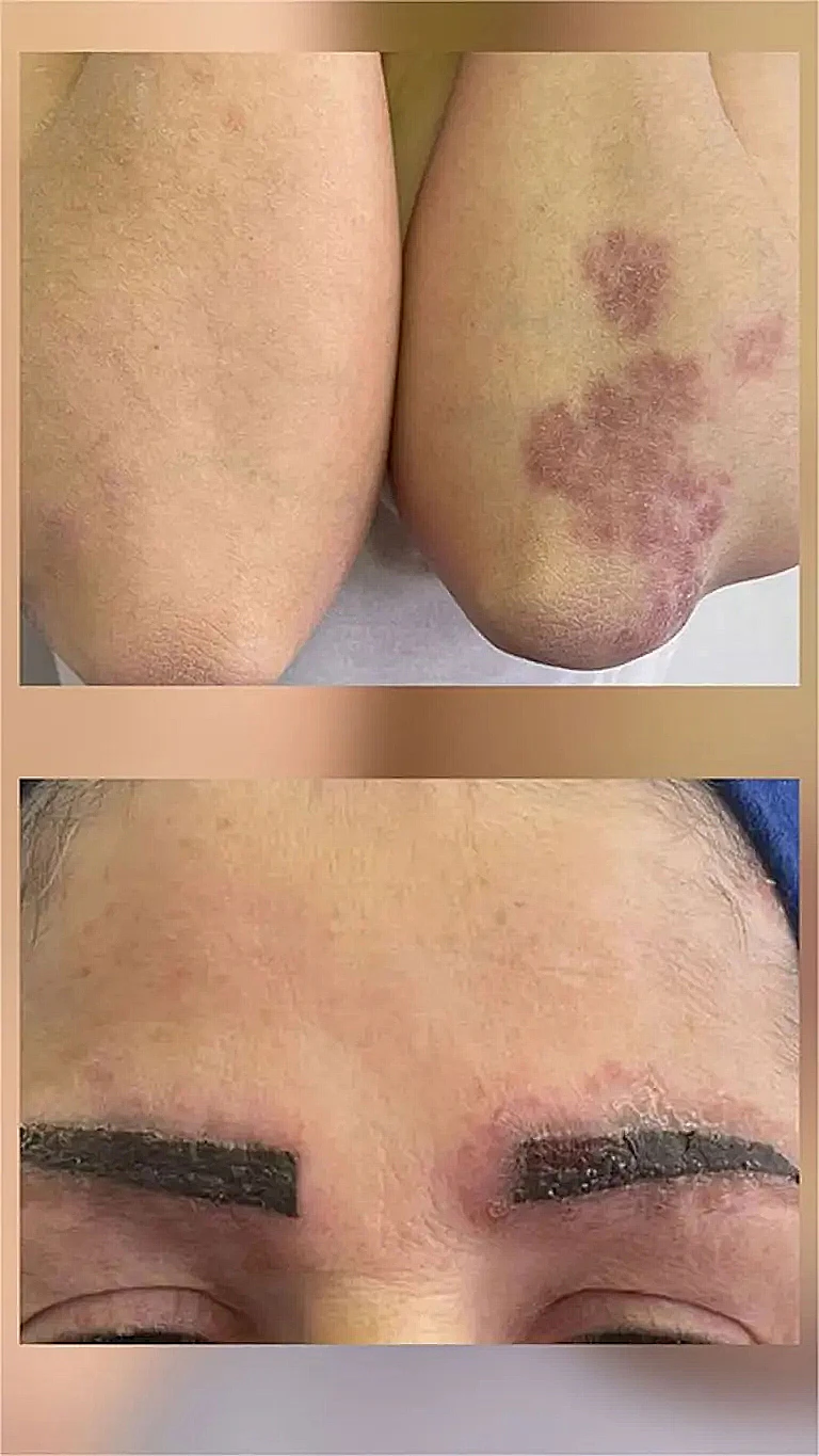 סרקואידוזיס, מחלה דלקתית נדירה יחסית