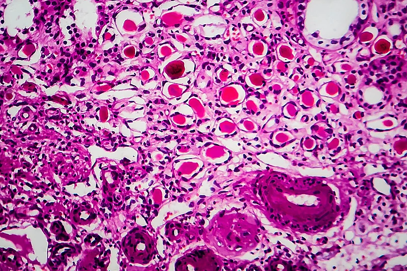 בדיקת ביופסיה שביצעה גילתה גרנולומות, הצטברות של תאי דם לבנים דלקתיים