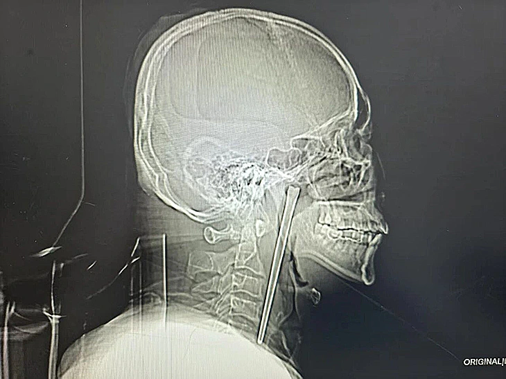 בלע את מקל האכילה בטעות בזמן שאכל לפני שמונה שנים