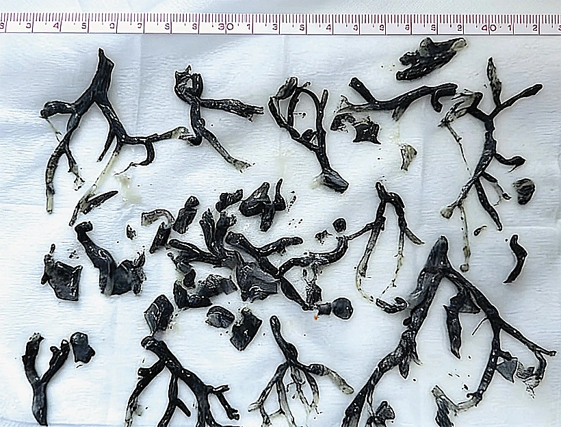 ריאות של בן 87 התמלאו בענפים שחורים