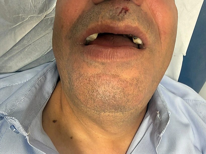 הנהג מ' שהותקף על ידי בני נוער ששברו את שיניו