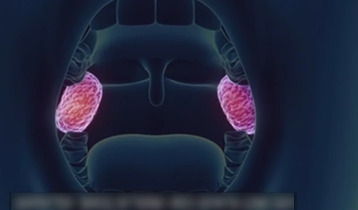 הדמייה של השקדים