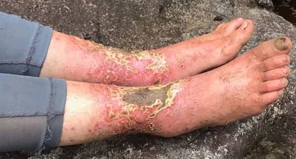 אמנדה הלר שהלכה לאיבוד ביער בהוואי ושרדה במשך 17 ימים